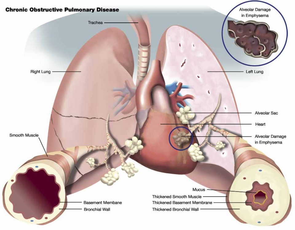 pulmonary disease